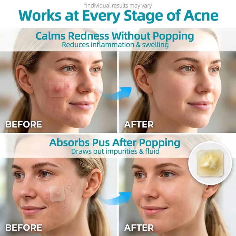 Grade Hydrocolloid Acne Patch, Acne spot treatment