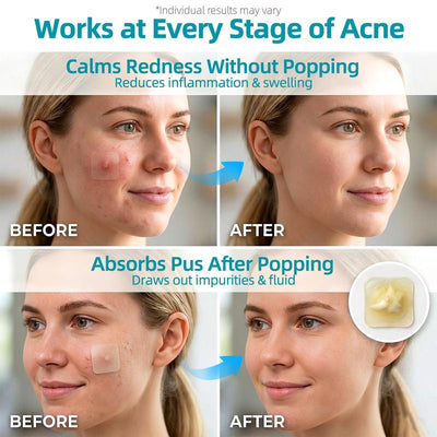 Grade Hydrocolloid Acne Patch, Acne spot treatment