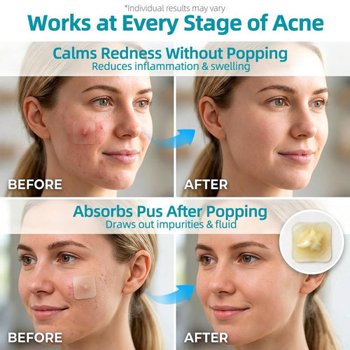Wileva™ ClearSkin Hydrocolloid Roll. Cover More. Wake Up Clearer.