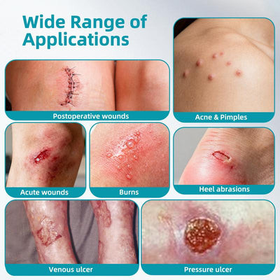 Grade Hydrocolloid Acne Patch, Acne spot treatment